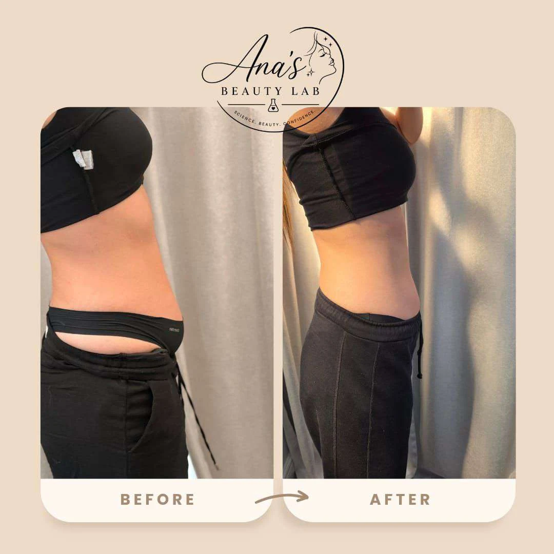 Body contouring client before and after, example 1