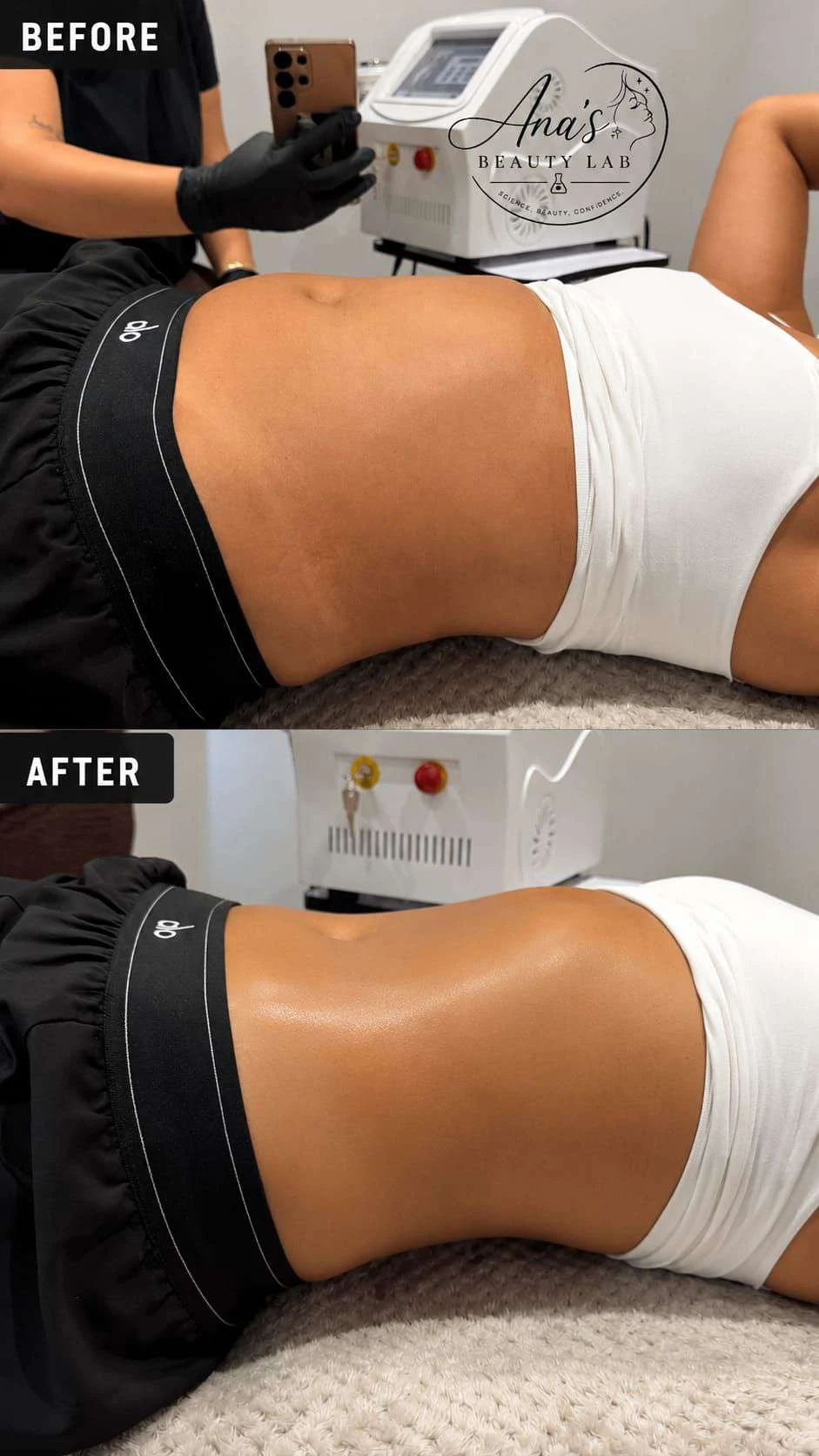 Body contouring client before and after, example 2