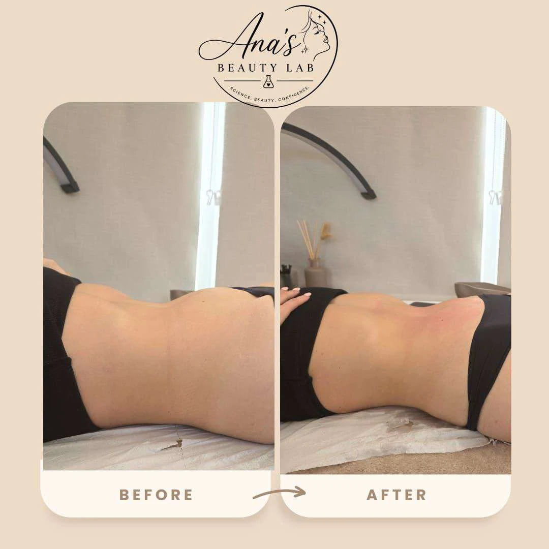 Body contouring client before and after, example 3