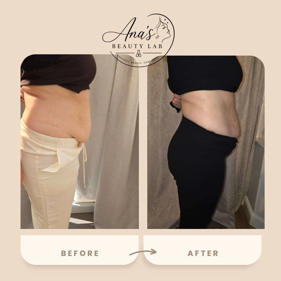 Body contouring client before and after, example 4