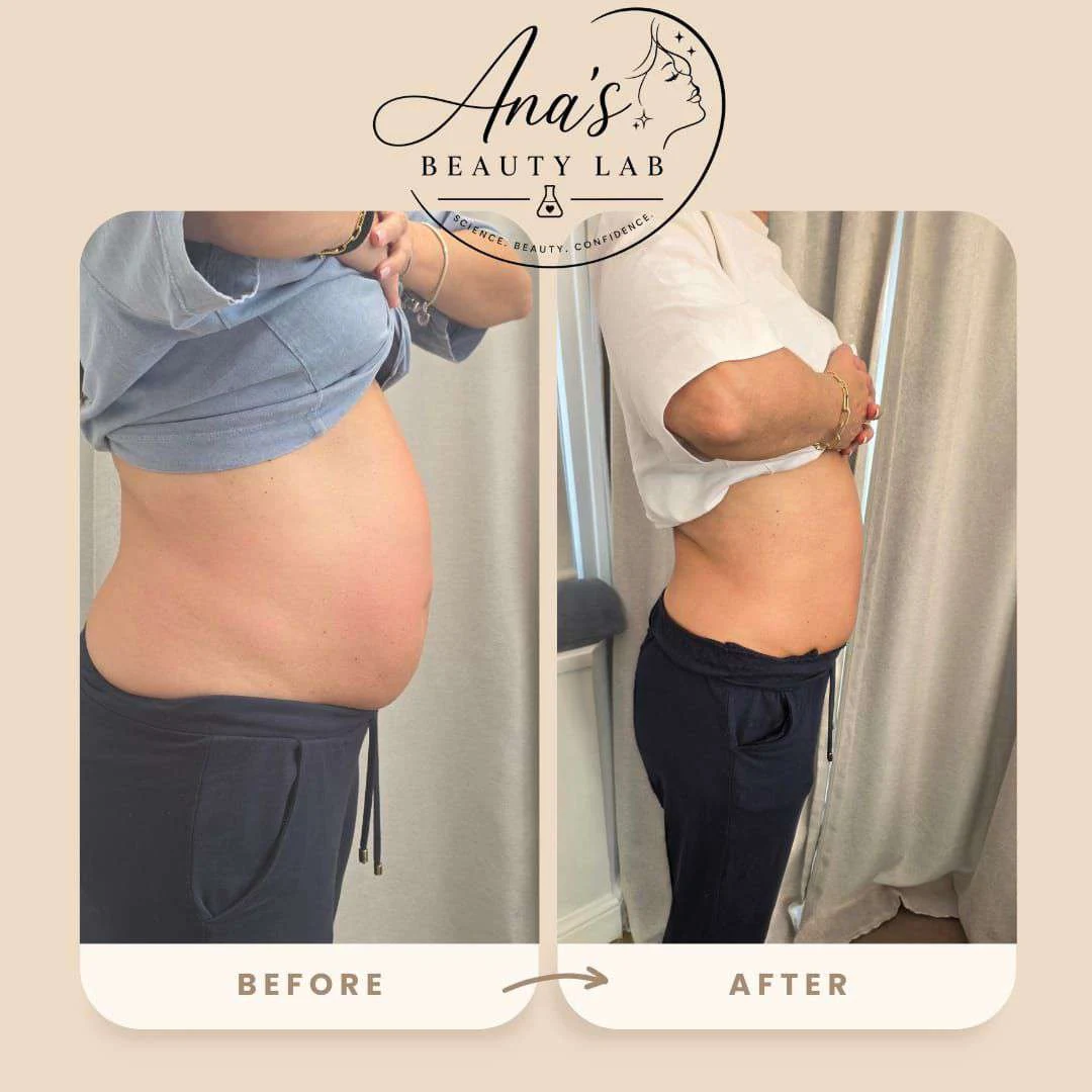 Body contouring client before and after, example 5